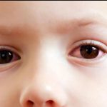 بیماری قرمزی چشم به چه دلیلی بروز می نماید و روش پیشگیری و درمان آن چگونه است