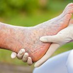 زخم وریدی پا : علل ابتلا و روش های مراقبتی و درمان زخم وریدی پا در سالمندان