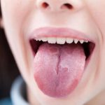 هر آنچه که لازم است در مورد پسوریازیس دهانی بدانید