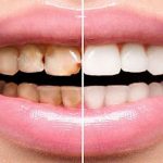 پاسخ متخصصان به رایجترین سوالات درباره لمینت دندان