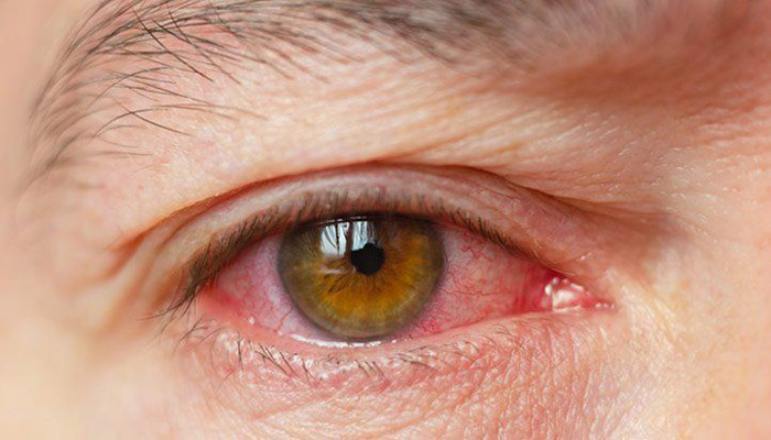 چرا چشم افراد سالمند خشک می شود؟