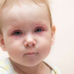 عفونت چشم در نوزادان