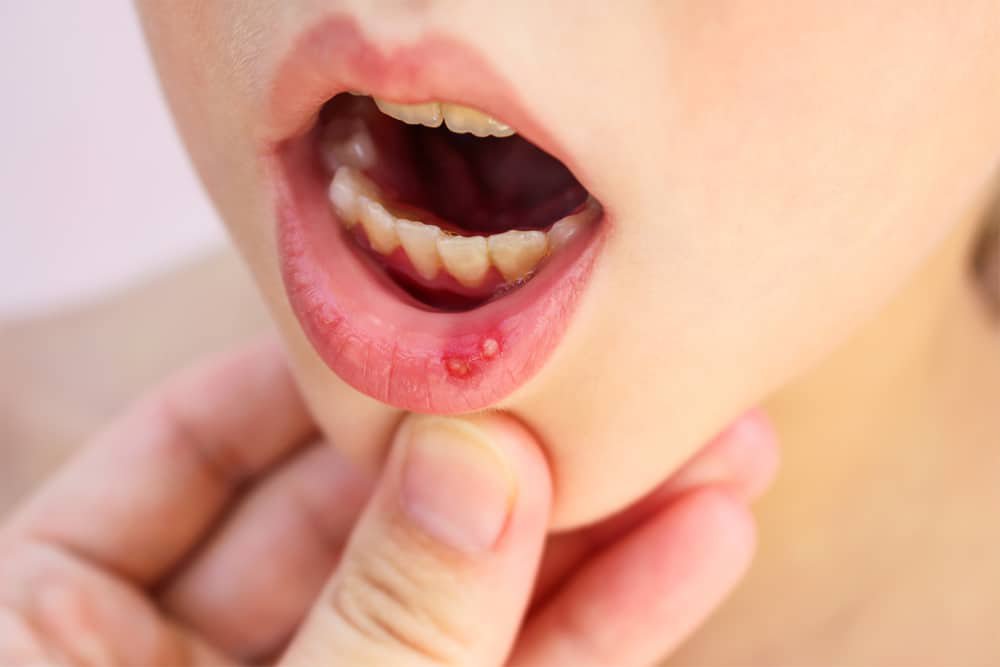 آفت دهان در کودکان | ۳ مدل اصلی آفت دهانی